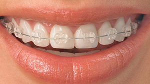 Ceramic-Braces Greater Houston Orthodontics Houston TX