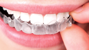 Invisible Braces Greater Houston Orthodontics Houston TX