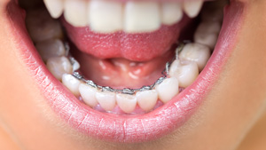 Lingual-Braces