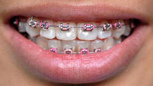 Metal Braces Greater Houston Orthodontics Houston TX