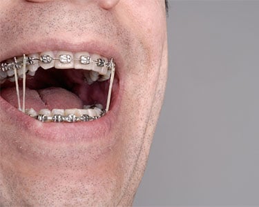 blog-featured-image-elastics-for-braces