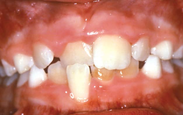 Crossbite Greater Houston Orthodontics in Houston, TX