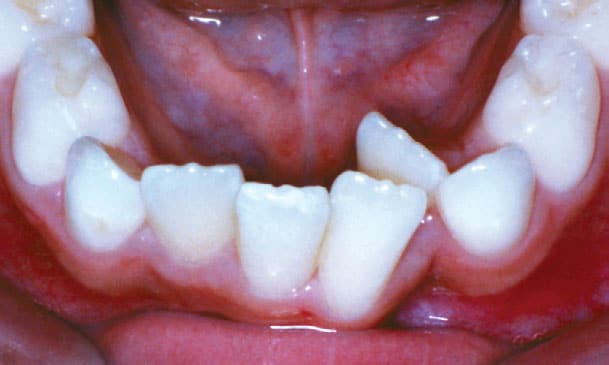 Crowding Greater Houston Orthodontics in Houston, TX