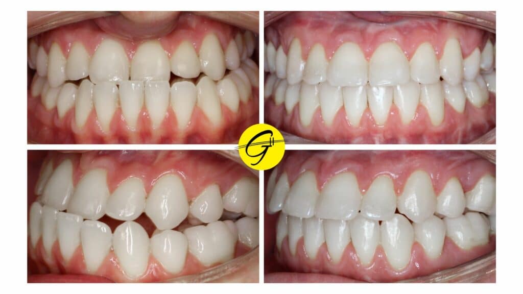 Before and after portraits of a young man showing a properly aligned bite after underbite correction with braces and surgery, with intraoral images showing the lower and upper teeth now meeting correctly at Greater Houston Orthodontics in Houston, TX