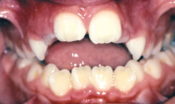 Open Bite Greater Houston Orthodontics in Houston, TX