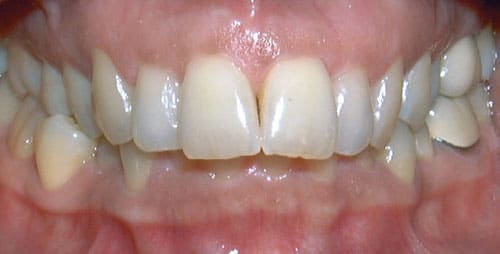 Overbite Greater Houston Orthodontics in Houston, TX