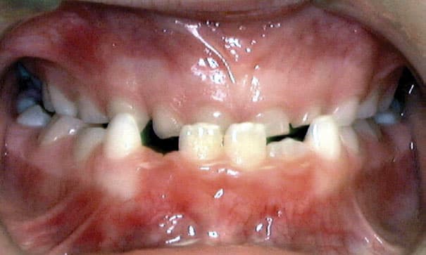Underbite Greater Houston Orthodontics in Houston, TX