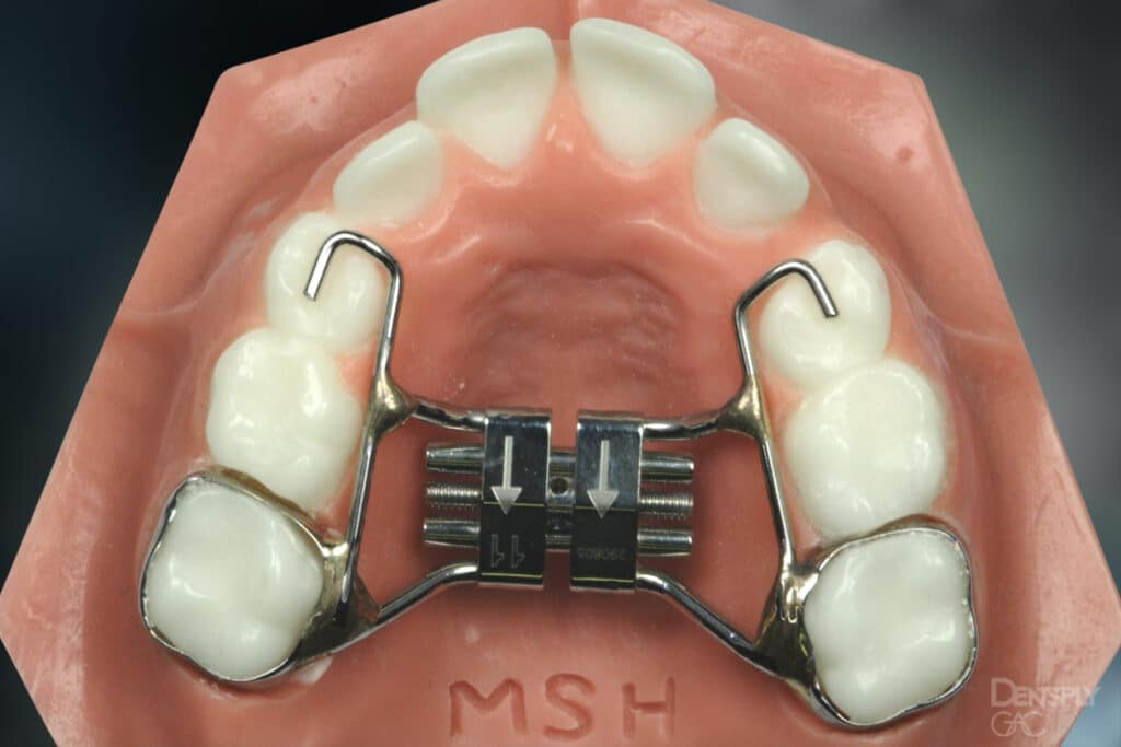 Fixed Orthodontic Appliances Greater Houston Orthodontics in Houston, TX