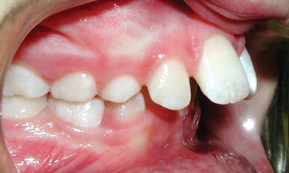 dental protrusion