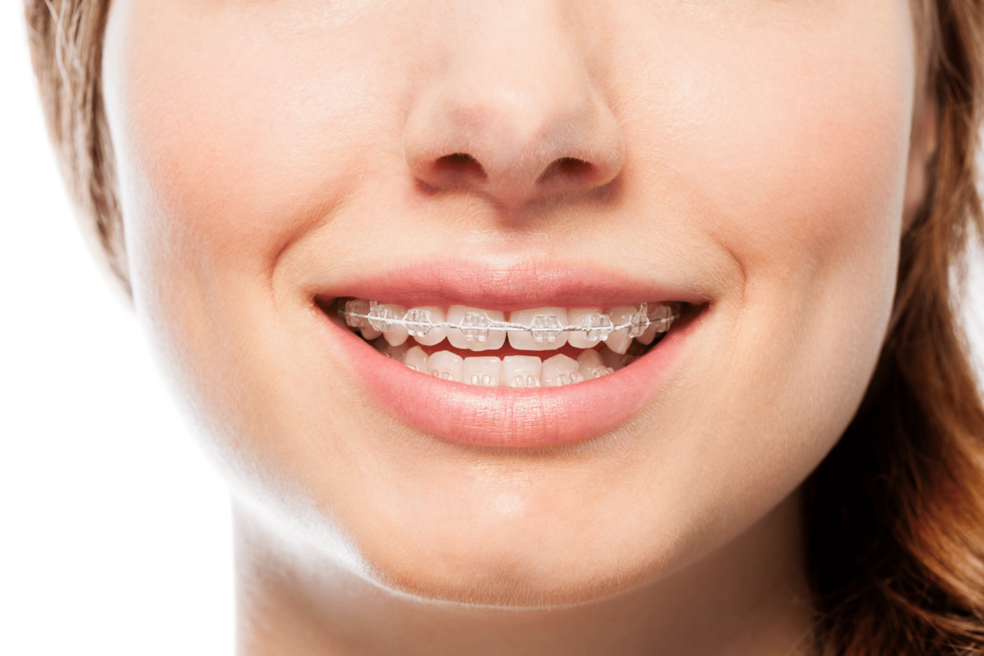Close-up of a person smiling while wearing clear ceramic braces